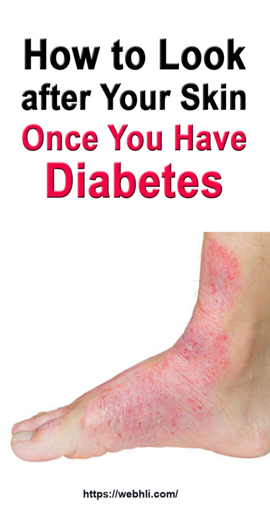 How to Look after Your Skin Once You Have Diabetes | Healthy Lifestyle