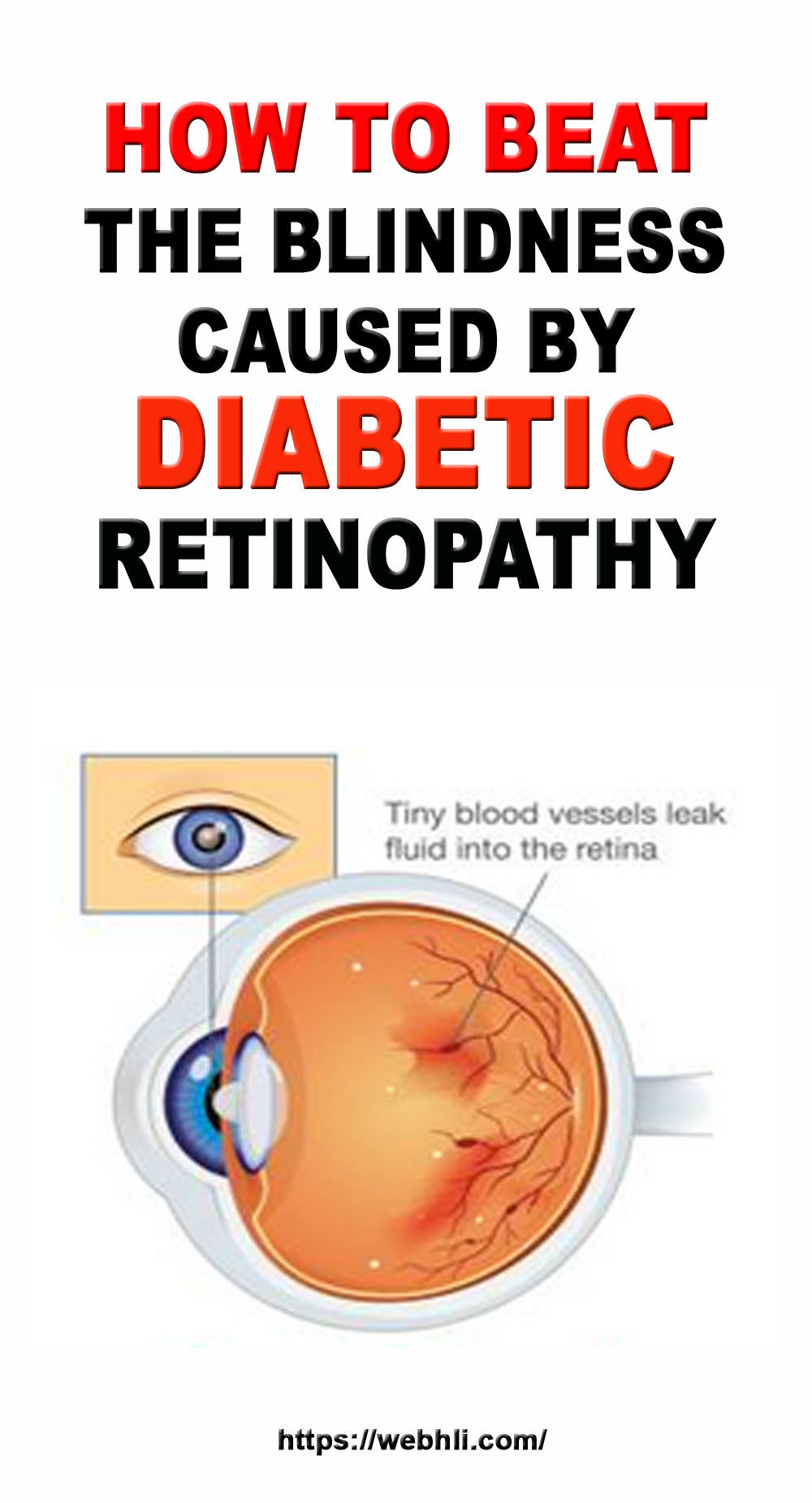 How to Beat the Blindness Caused by Diabetic Retinopathy | Healthy ...