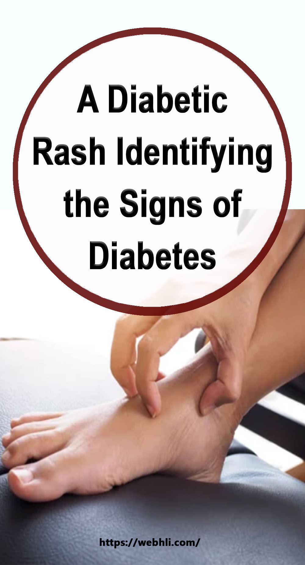 A Diabetic Rash – Identifying the Signs of Diabetes | Healthy Lifestyle