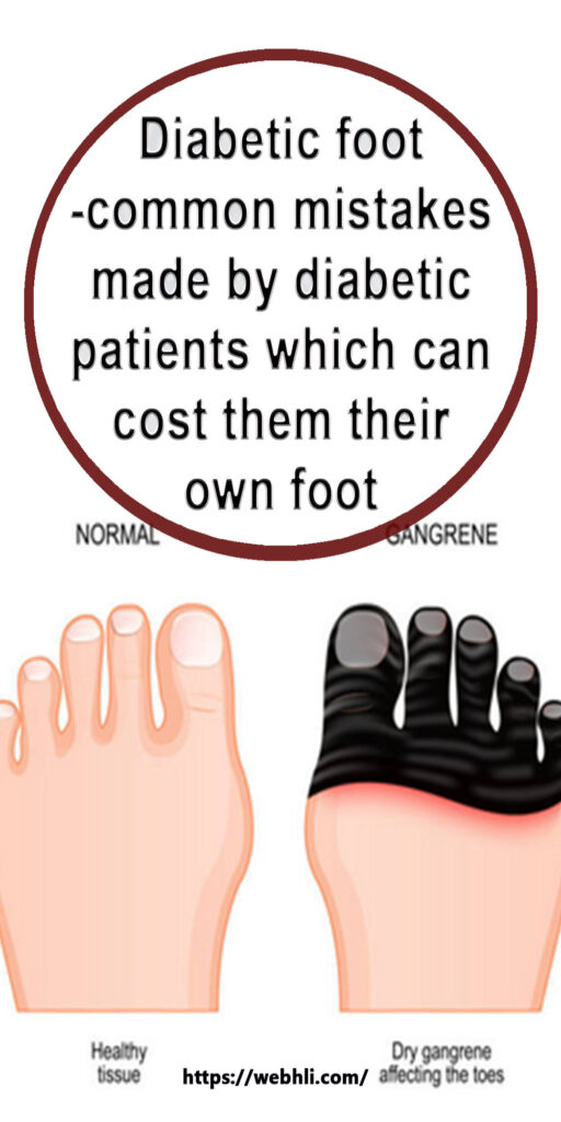 Diabetic foot -common mistakes made by diabetic patients which can cost ...